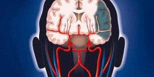 脑血栓可以吸电子烟吗？